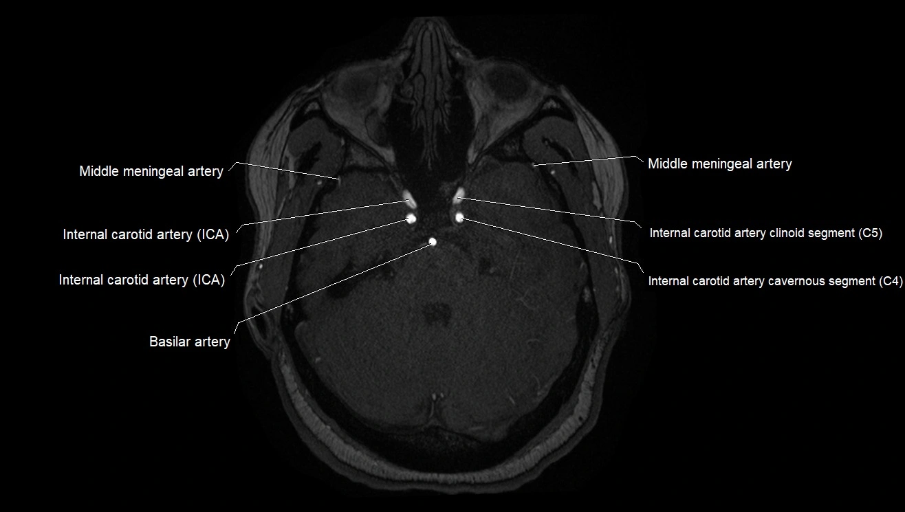 MRA brain (cerebral arteries) anatomy axial 3T image 7.webp
